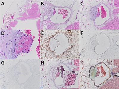Case Report: Acute Thrombotic Angiopathy of Atrial Appendage Epicardial Veins: A Seemingly Innocuous Finding Portending a Fatal Outcome